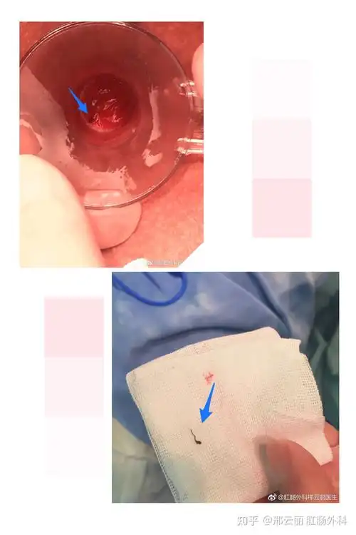 如有确认是吻合钉引起的出血疼痛不适,且确认钉子位置,可以再次手术取