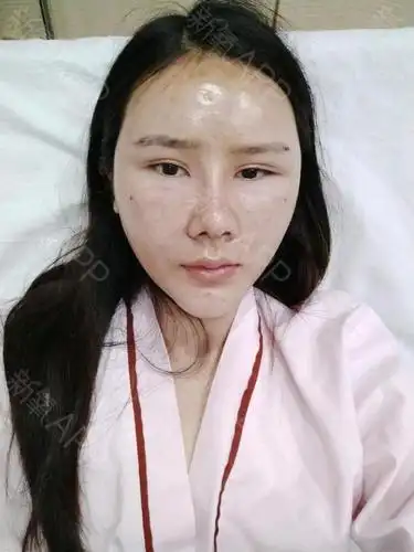 自体脂肪面部填充