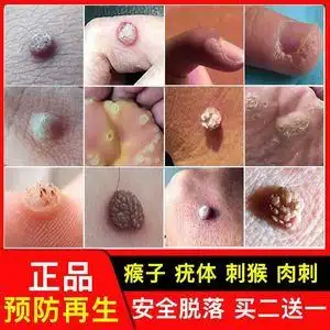 祛肉瘤皮赘去除膏猴子脖子上长的小肉粒疙瘩点瘊子痦子药肉痣神器