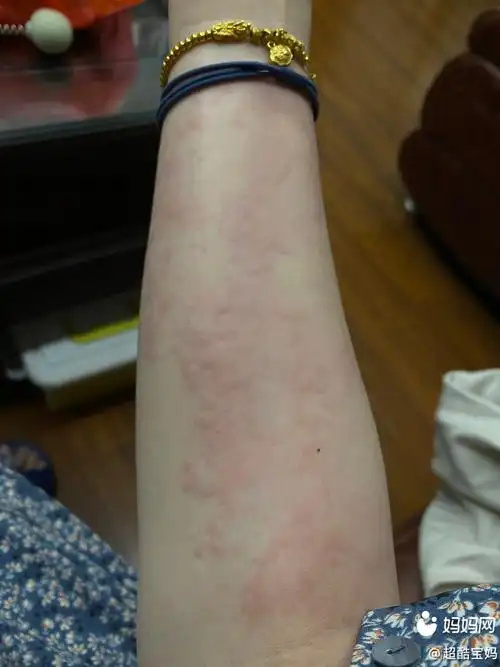有没有孕妈孕期的时候全身都长好多这样的红疹,怎么好_妈妈网孕育社区