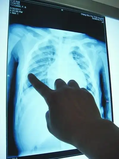 胸部7根肋骨骨折