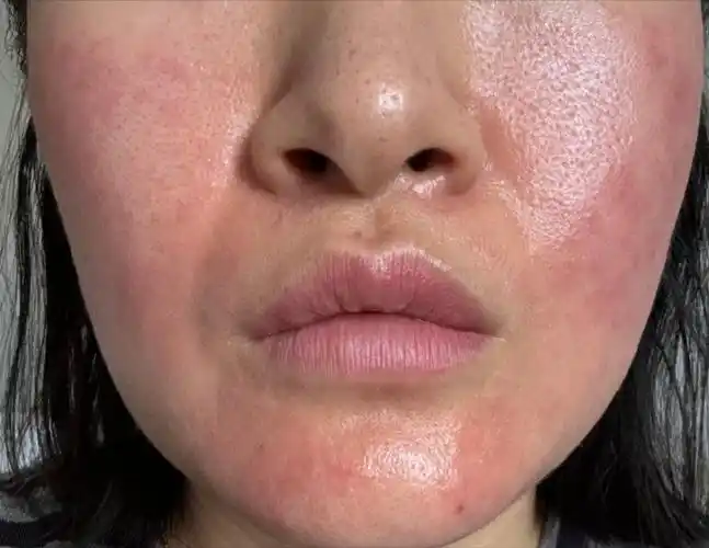 为什么假期过后,皮肤问题集中出现呢?