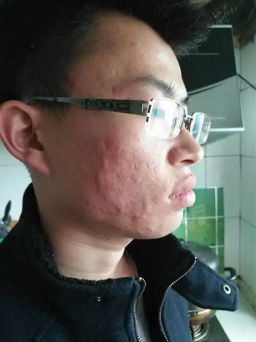 脸油到底是什么原因导致的?