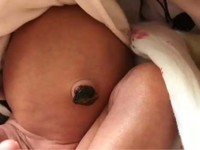 我家宝宝刨腹今天第八天,肚脐眼上长水泡怎么办啊