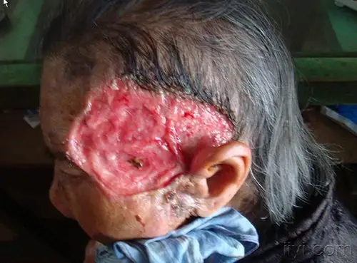 一例罕见的大面积皮肤溃疡(外加方子)