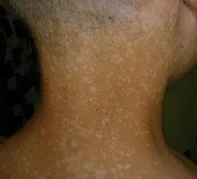 汗斑又称花斑癣,是一种浅部真菌病,皮肤损害以淡白色为主,呈圆形或卵