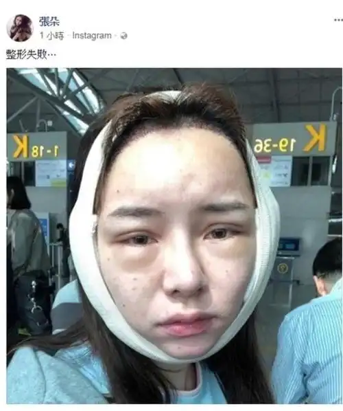 女星整容失败,脸肿得认不出来,网上大呼求助