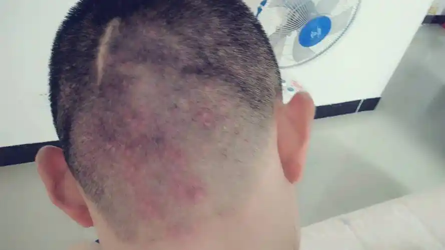 我头上有毛囊炎,好治疗吗?抹了好多药都不好.