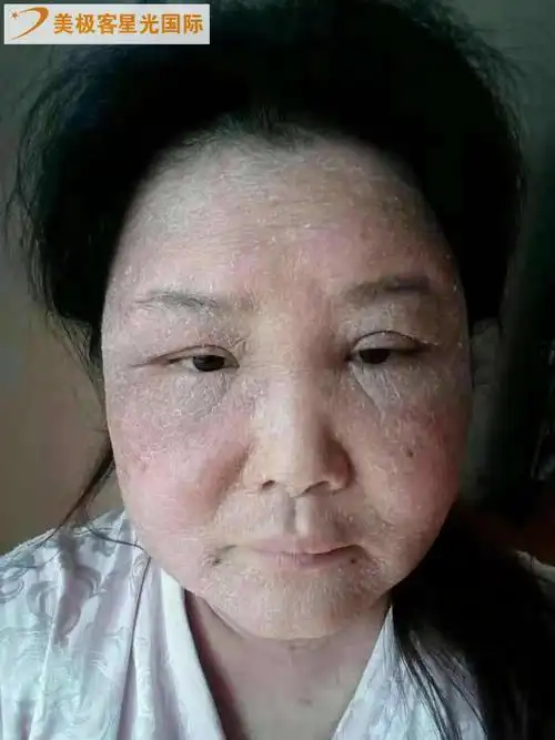 【视频】急性肾炎脸肿无尿现在她又变回美丽_泌尿系