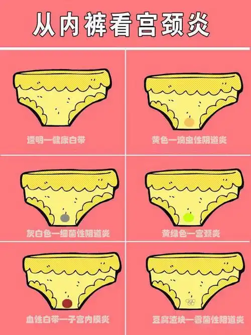 白带是女性的阴道分泌物,正常为白色无特殊气味,质稀薄,略黏稠.