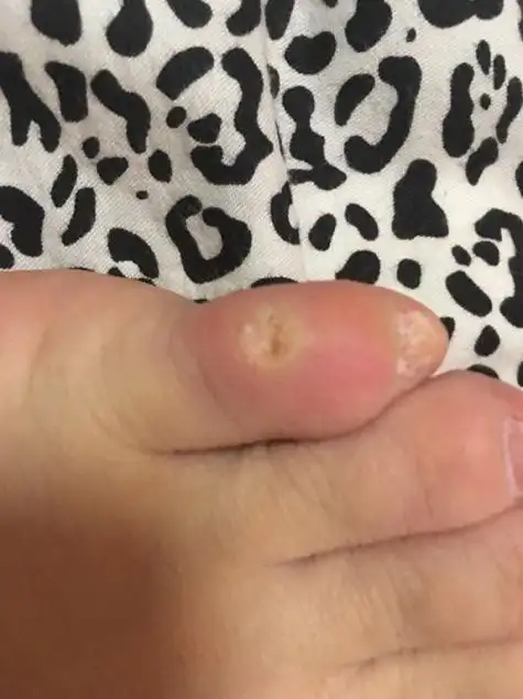 我小脚趾有硬硬的突起来的白色呈透明状好像是鸡眼好像是脚钉好像是硬
