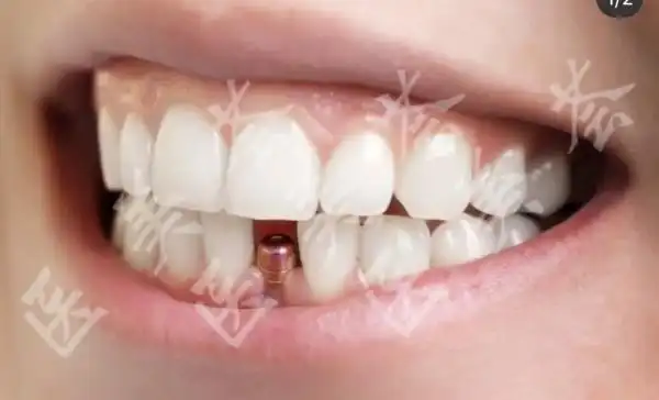 真人种植牙图片