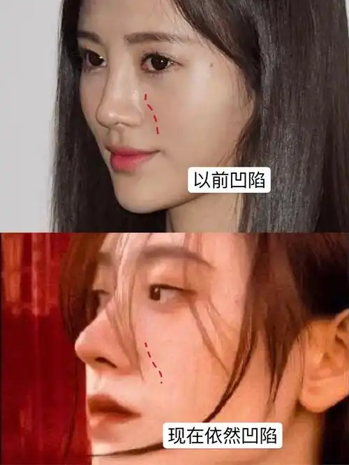 鞠婧祎从土鳖少女到现在的洋气精致脸,鼻子应该是调整最多的.