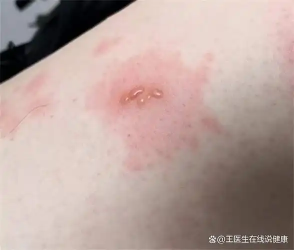 艾滋病都有哪些传播途径?