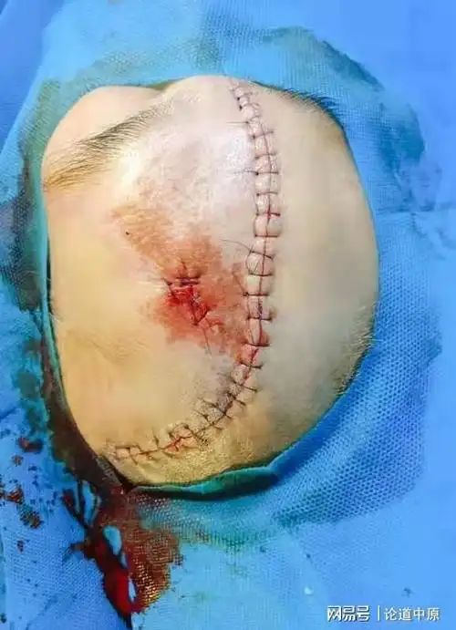 南阳女子在家不慎摔倒头皮撕脱惨不忍睹外科医生40分钟成功修复