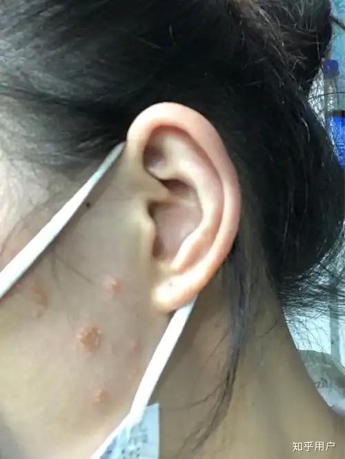 扁平疣爆发是什么样的啊