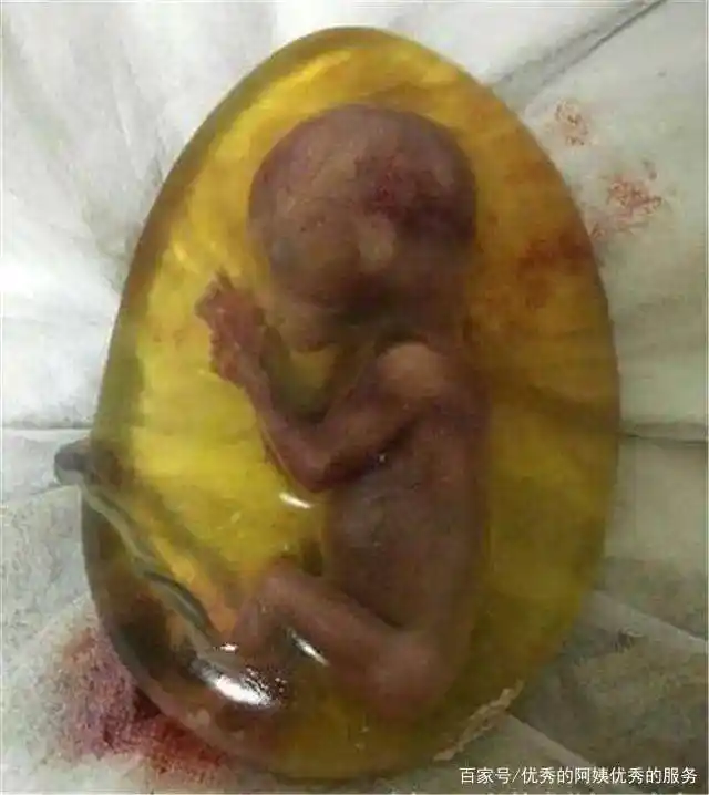 四个月胎儿怎么引产