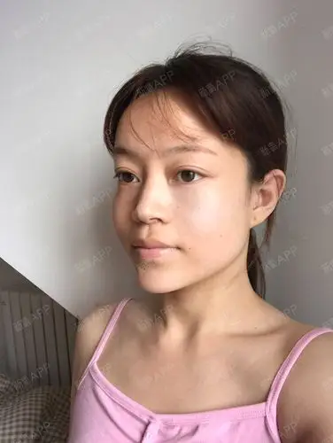 脂肪填充全面部术后7天