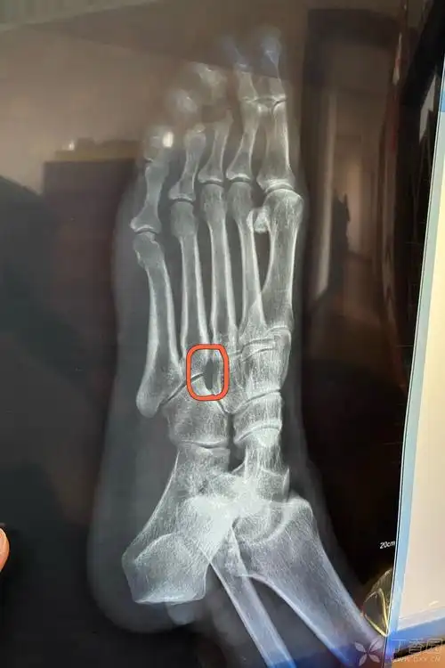 各位觉得左脚第四跖骨基底有无问题?