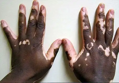 各种常见皮肤病种类图片及症状对照大全查看