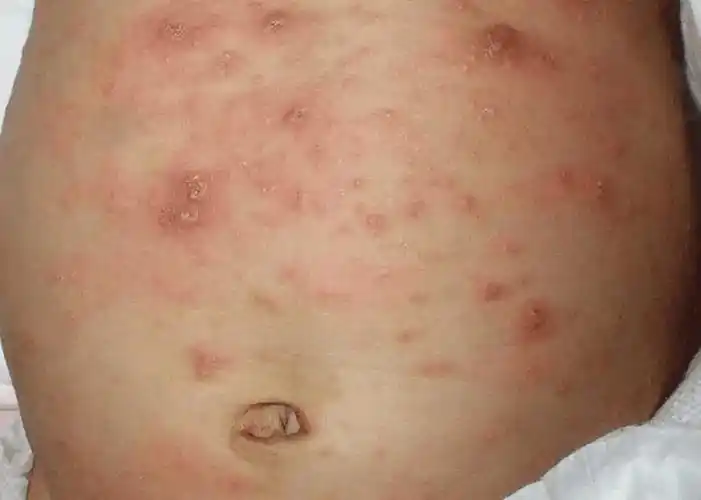 6,高传染性:疥疮是一种高度传染性的疾病,可以通过密切接触或共用被褥