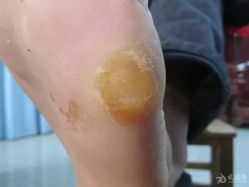 双足底黄色硬块——胼胝