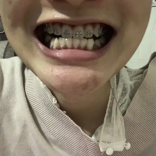 5号拔了左边上下四号牙 - 第3页 - 虎牙矫正 - 牙齿矫正人气社区-牙套