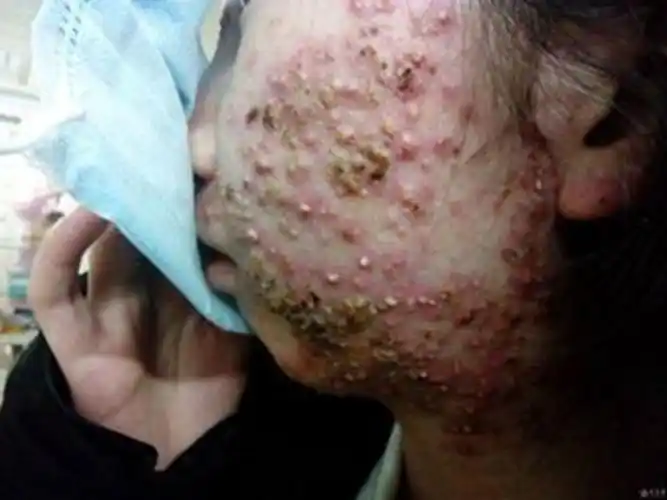 阴茎长毛囊炎的症状图片