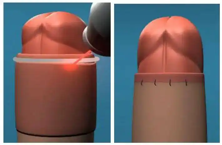 成人包茎手术25天恢复图片