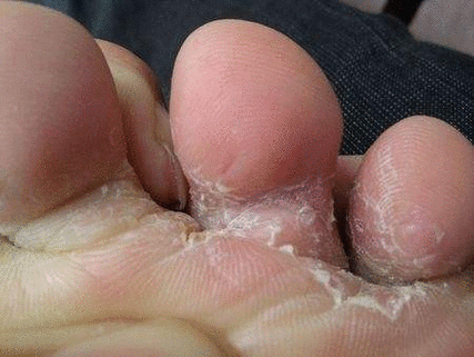 脚酸臭,脚后跟开裂,丑到极致,用它一抹 不臭了,脚丫子白嫩发光!