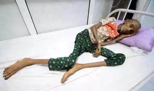 瘦如皮包骨头的十八岁女孩,只因为没有吃的