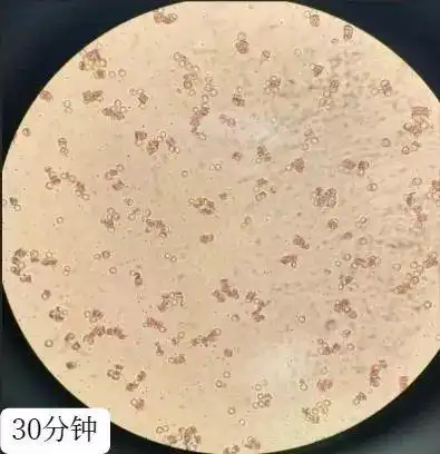 因意外抗体假凝集导致的交叉配血不合却意外发现镜下桃源