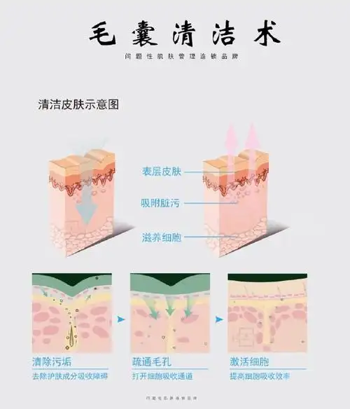 禾壹净毛囊清洁术,一次彻底清理垃圾