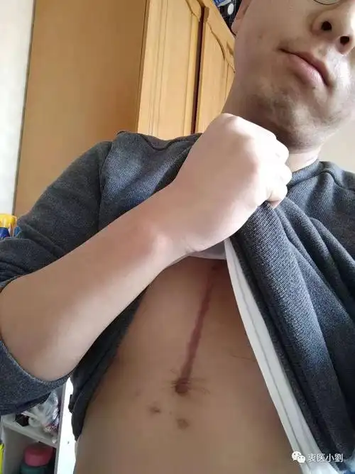 一年前的今天我做个了开胸手术