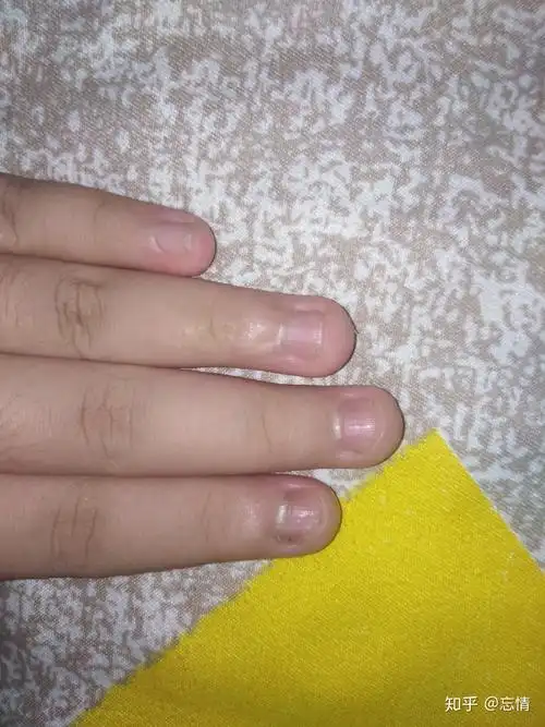 长期咬指甲现在决心戒掉可以恢复吗