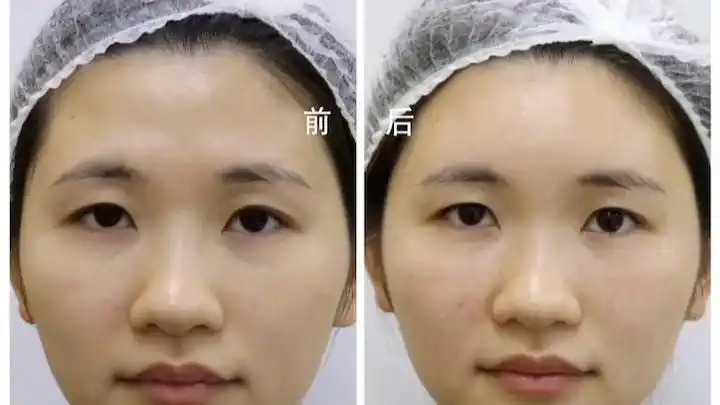 填充额头前后对比图不止是在视觉美学上变好看了天庭饱满更有福气让