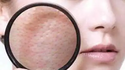 脸部皮肤粗糙要如何解决