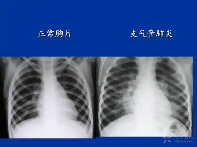 小儿肺炎好治吗