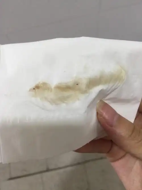 怀孕初期褐色分泌物别担心