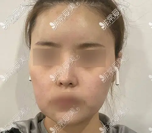 脂肪填充失败的案例vs脂肪填充成功案例看完惊呆