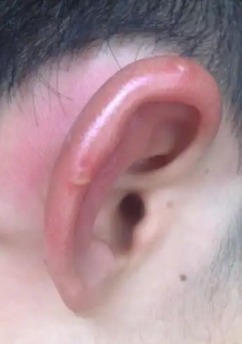 耳朵突然很痒,而且红肿,然后还起了泡,巨痒无比,请问大仙们这是怎么