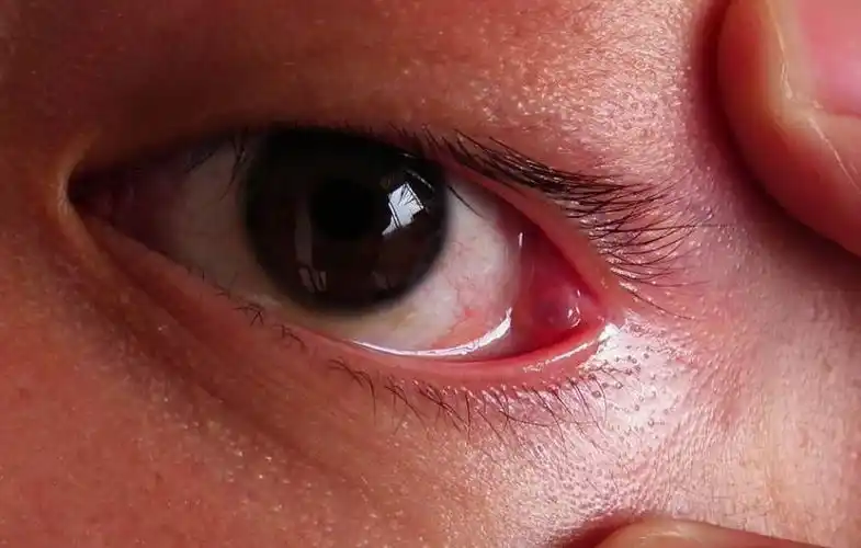 外眼角内长个水泡,怎么回事