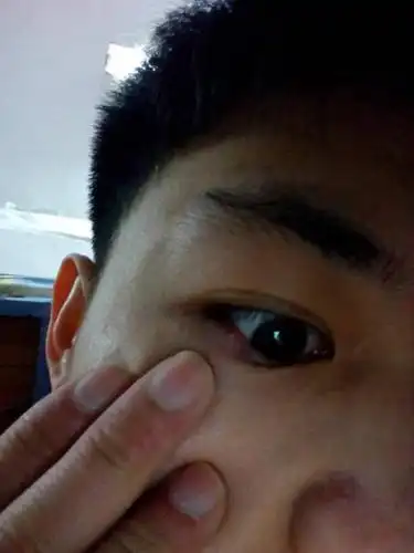 排序 4条回答  4 分钟前 huagzhankun|来自手机知道|五级 这是麦粒肿