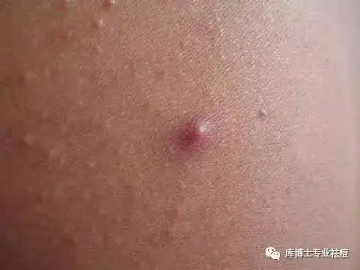 库博士小讲堂毛囊炎的病因知多少