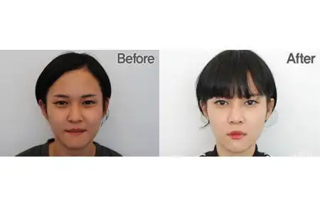 鼻头缩小术 给肥大的鼻子减减肥