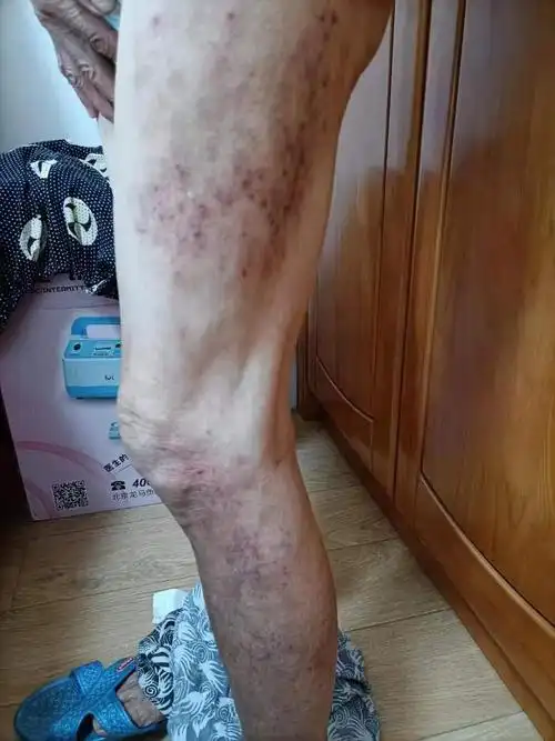 杨康医师 | 治好老太太顽固的干性湿疹