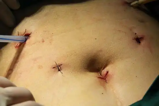 我院成功完成首例全腹腔镜下超低位直肠癌根治手术