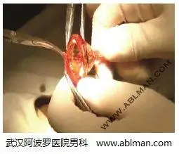 一次性包皮环切器:包茎手术过程实图直播