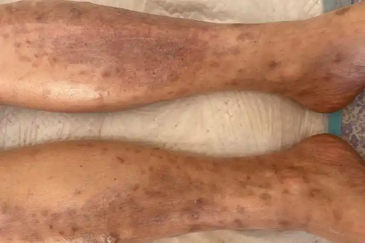 过敏性皮炎图片和症状