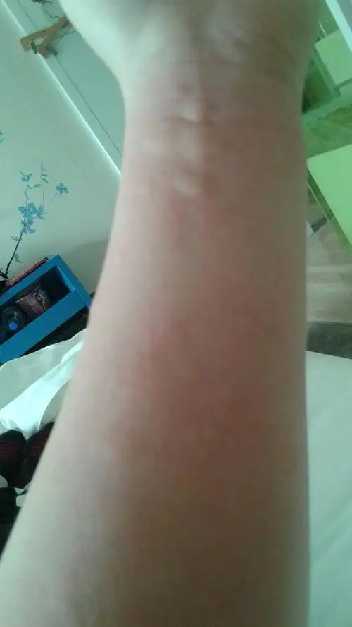 不知道怎么了,全身都是这样的包,我在旅游难道是水土不服,还是沐浴露